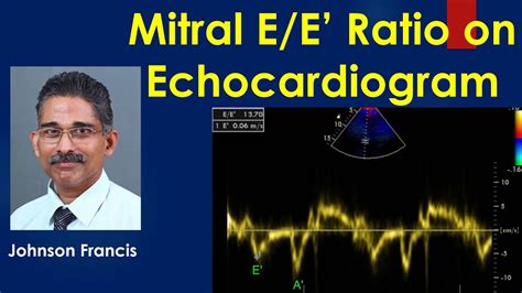 Mitral E/E’ ratio on echocardiogram 